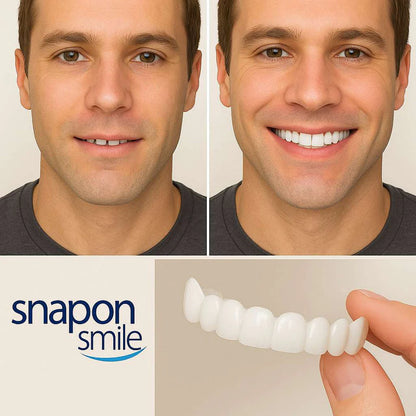 Carillas Dentales SnapMile | Luce una Sonrisa Soñada